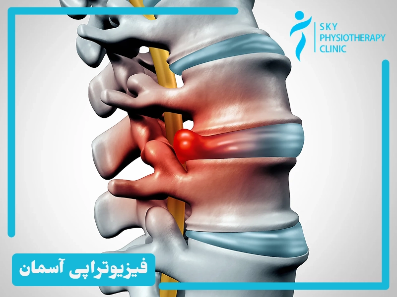 آب درمانی تنگی کانال نخاعی
