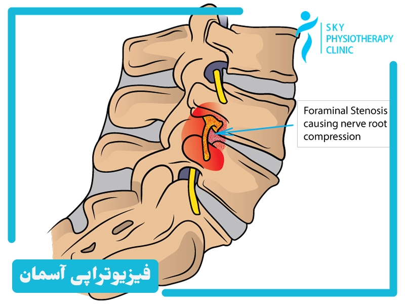 ورزش‌ ها و تمرینات مفید برای آب درمانی برای تنگی کانال نخاعی