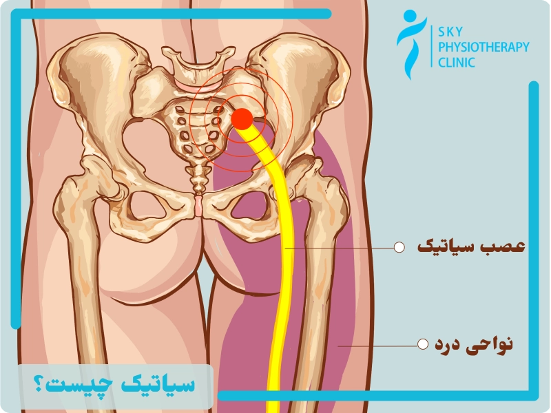 درمان سیاتیک
