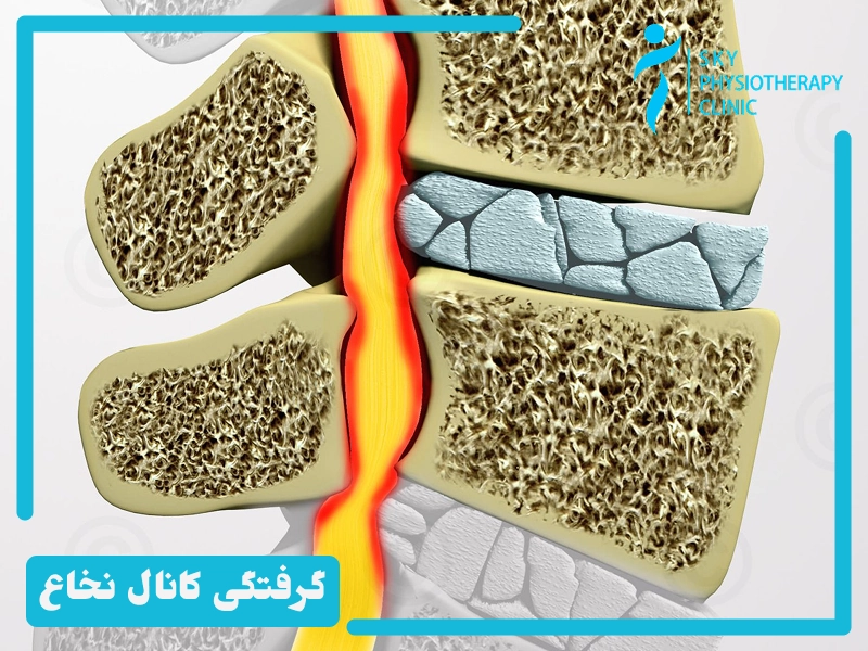 نقش فیزیوتراپی در گرفتگی کانال نخاع