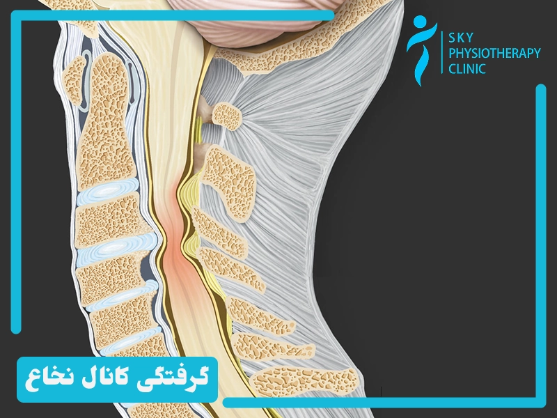 نشانه ها و علائم تنگی کانال نخاعی