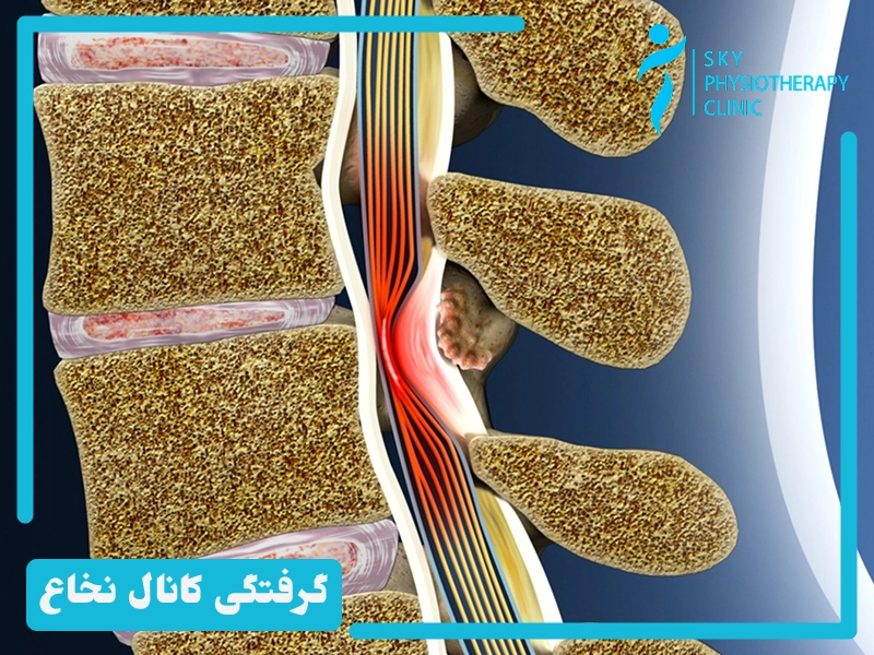 علل و عوامل موثر در گرفتگی کانال نخاع